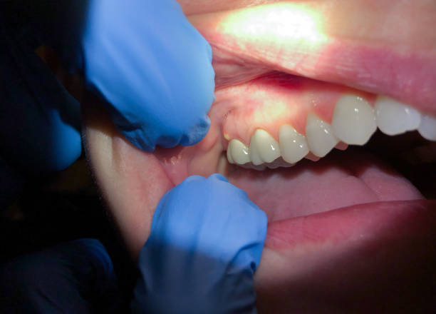 Best Emergency Root Canal Treatment in Edwards, MS