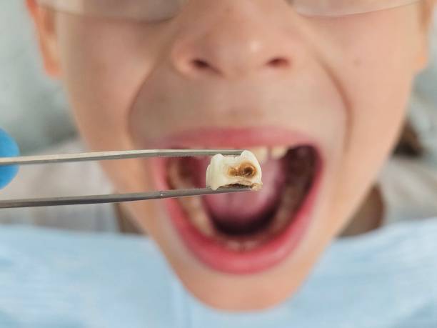 Best Urgent Care for Lost Fillings or Crowns in Edwards, MS